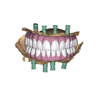 Implant Restorations