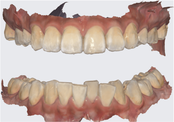 open bite scan.png